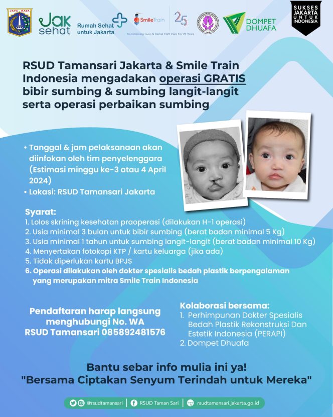 
 RSUD Tamansari Adakan Operasi Bibir Sumbing Gratis